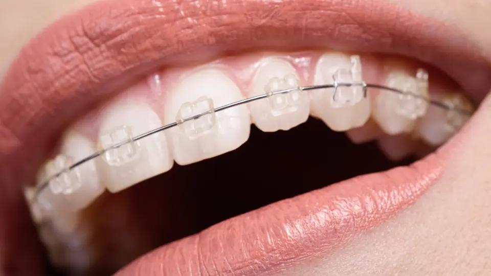 Image of ceramic braces in Canberra