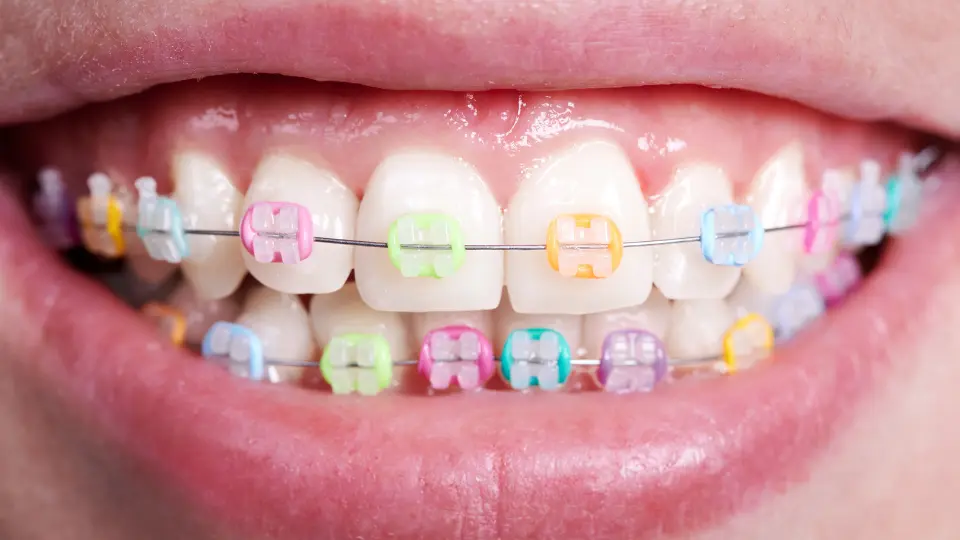 Image of coloured braces in Canberra